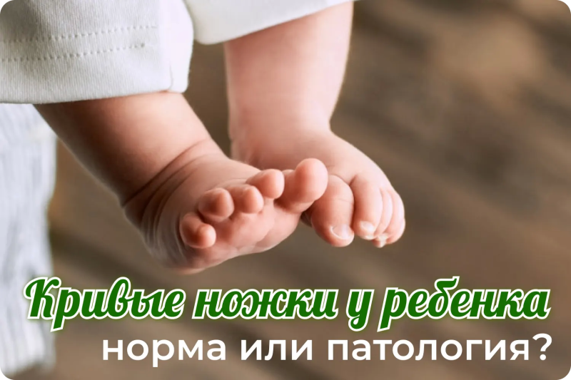  О-образные и Х-образные ножки у детей: когда это норма, а когда нужен детский ортопед?